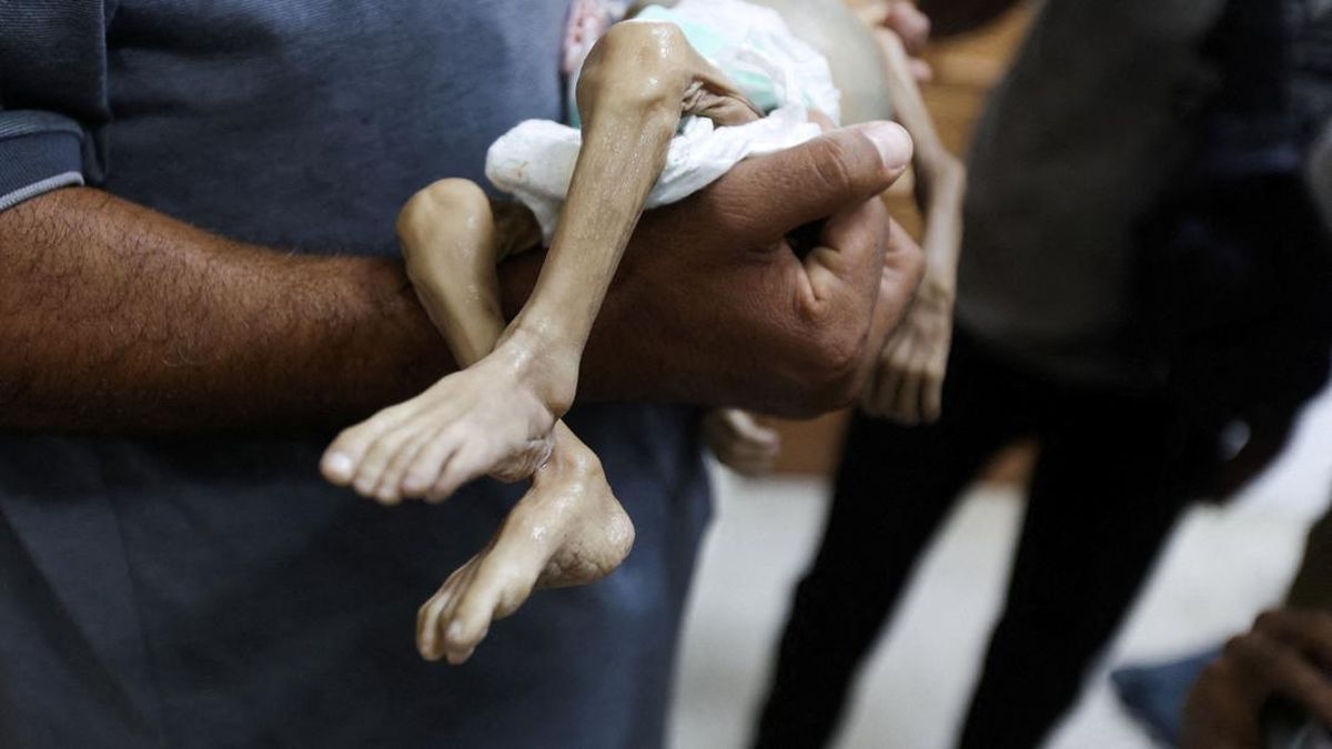 who-ungkap-kasus-malnutrisi-di-gaza-mengkhawatirkan